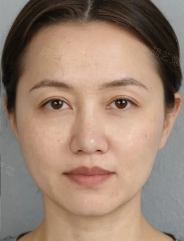 术后
