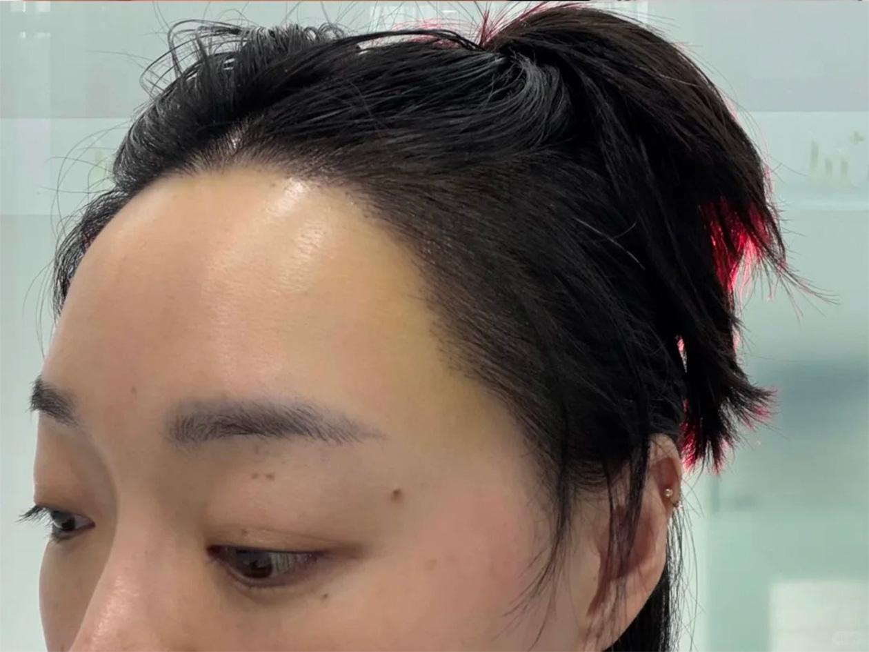 术后