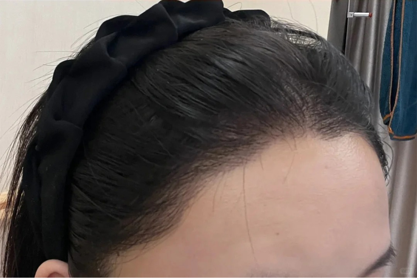 术后