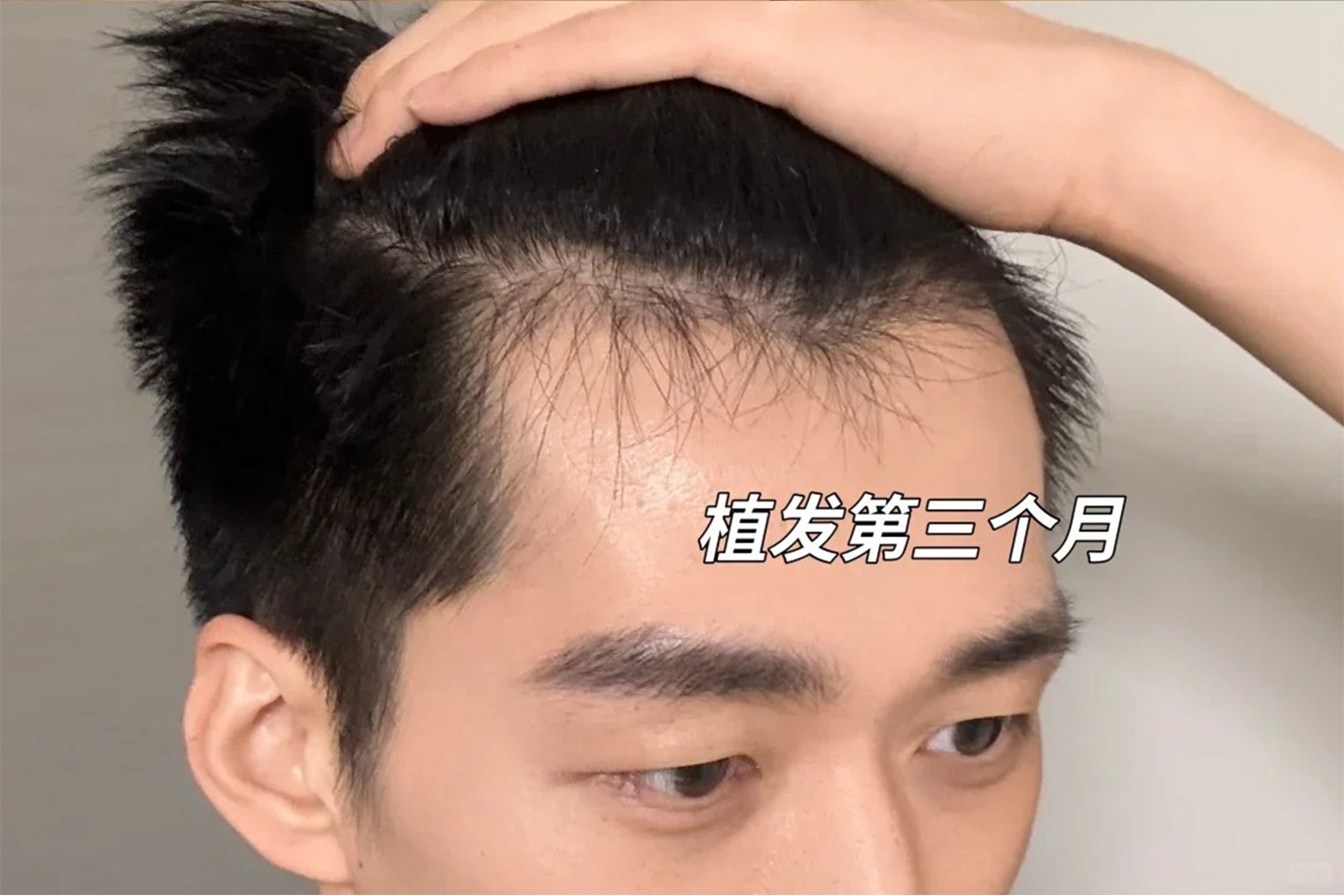 术后