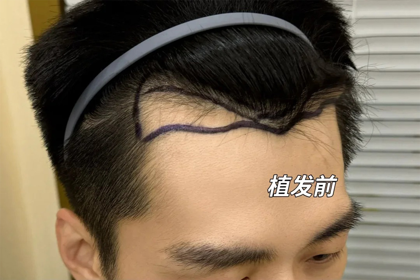 术前