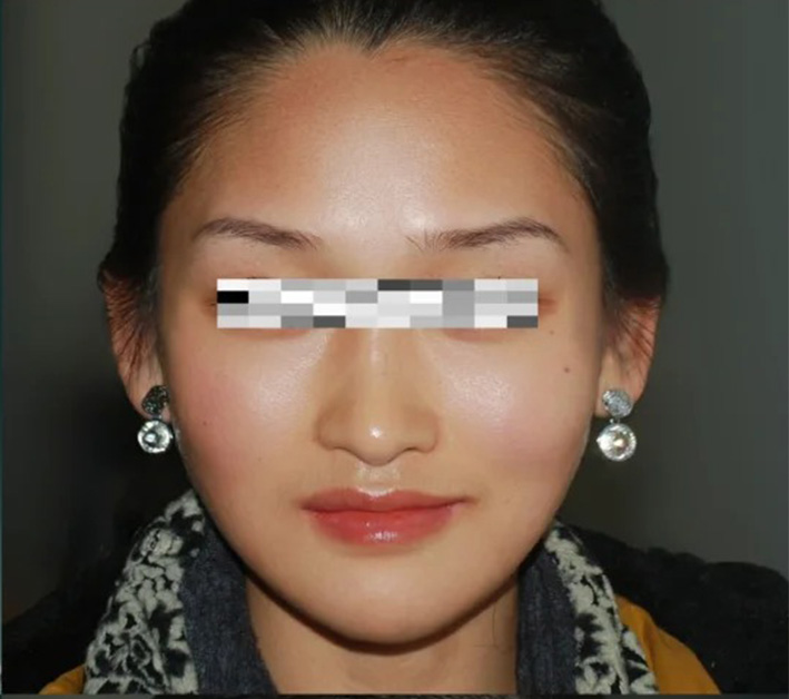 术后
