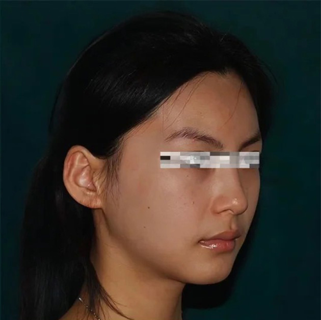 术后