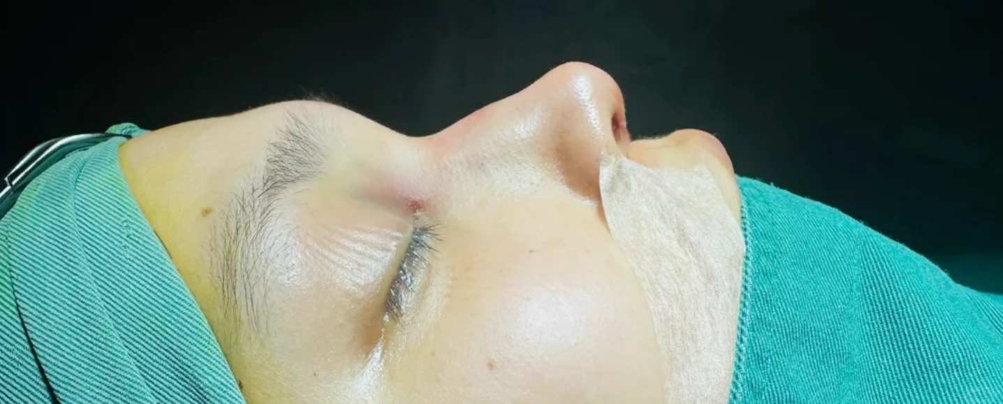 术后