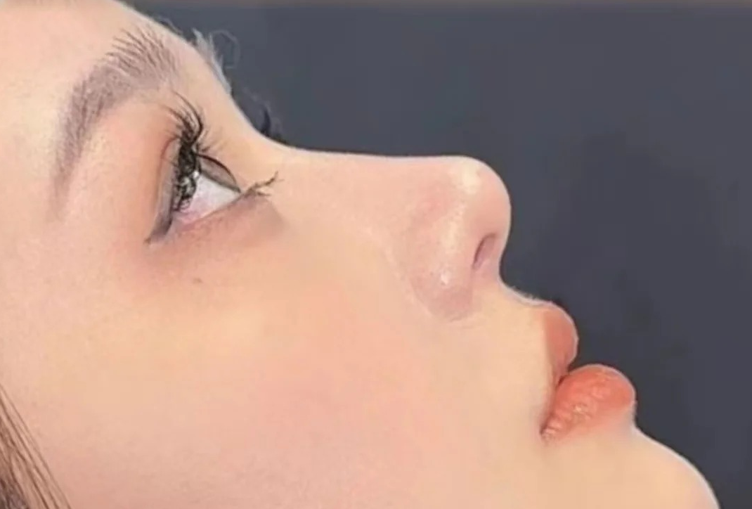 术后