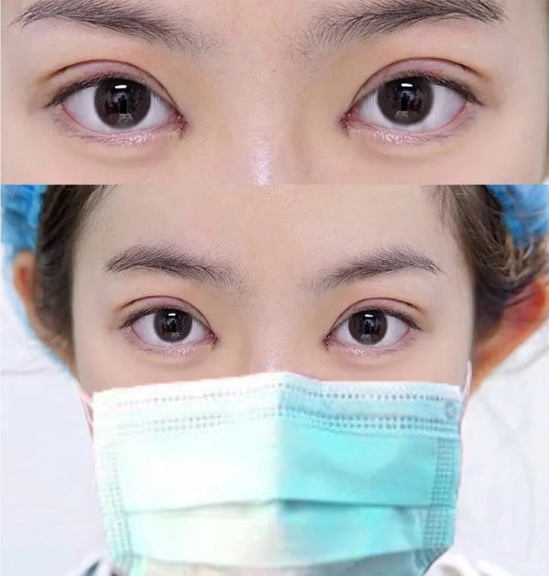 术后