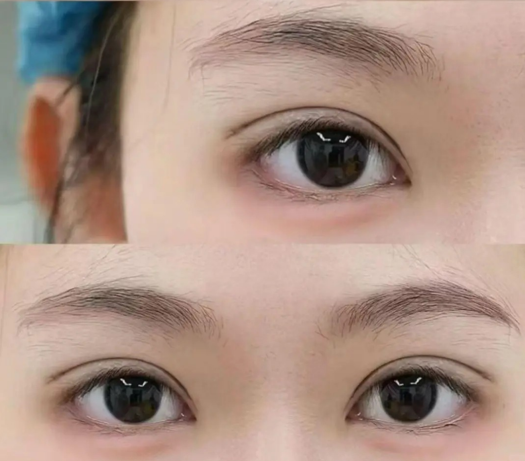 术后