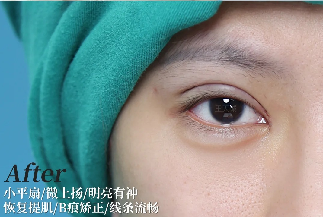 术后