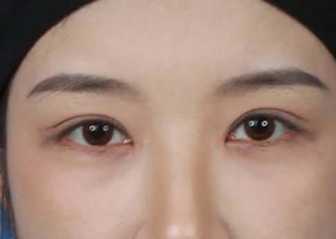术后